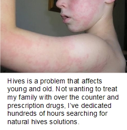 How To Get Rid Of Hives Fast