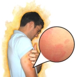 Treatment for Hives in Adults